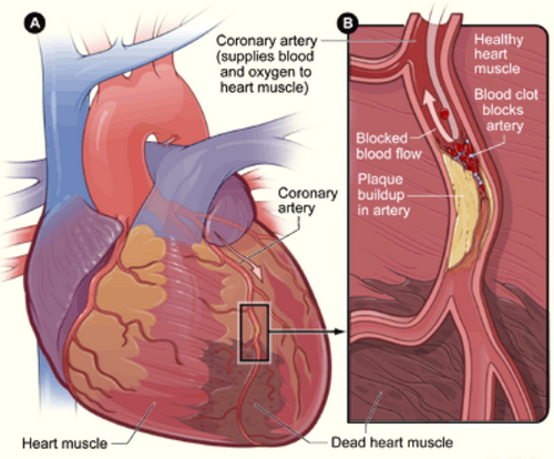 Apa Penyebab Penyakit Jantung Iskemik? perubahan hormonal